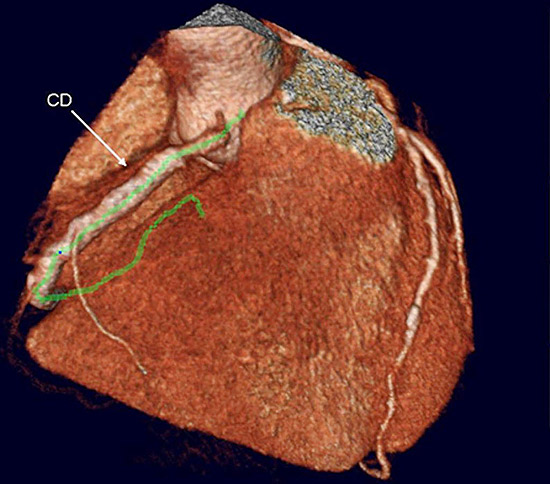 Tomografia de artérias coronárias em paciente com stent na artéria coronária direita(CD)