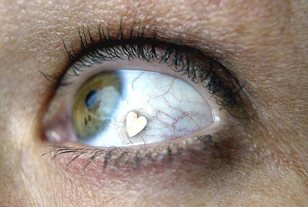 Joias implantadas no olho, que j so usadas h anos na Europa, so consideradas pouco seguras pelos mdicos