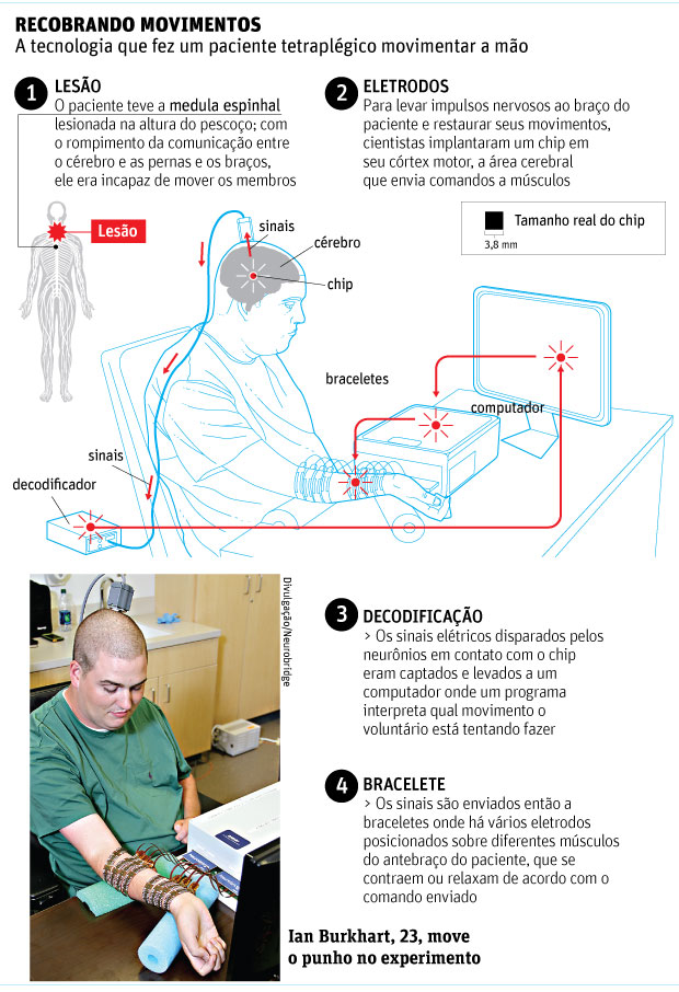 Chip no cérebro permite a tetraplégico voltar a mover a mão