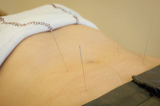 A acupuntura tambm pode ser usada, segundo Sley Tanigawa, para ajudar a prevenir a flacidez abdominal