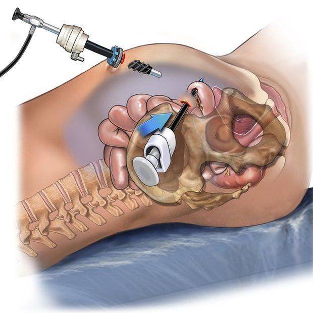 A laparoscopia  uma cirurgia pouco invasiva, em que so feitos pequenos cortes na parede abdominal para a introduo de cmeras, pinas e pequenos aparelhos para manipular os rgos e vsceras