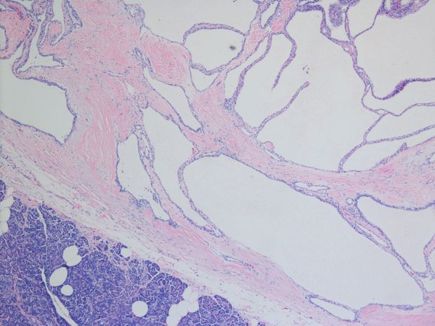 Adenoma (crescimento benigno glandular com potencial para causar problemas de saúde) no pâncreas 