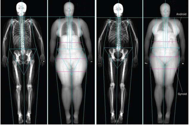 Radiografias de mulheres com idade, IMC e quantidade de msculo equivalentes; a da esquerda  metabolicamente saudvel e a da direita  resistente  insulina