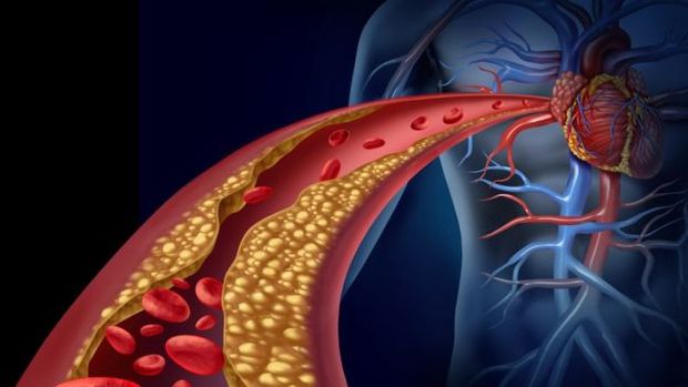 Artrias bloqueadas imperdem a circulao adequada do sangue