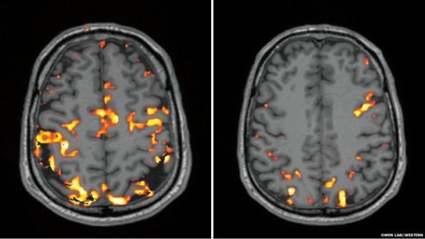  esquerda, atividade do crebro do reprter durante testes cognitivos depois de uma noite de sono normal, enquanto a da direita, do seu crebro privado de sono
