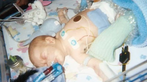 Liam quando beb; pais ouviram dos mdicos que o beb no chegaria a sobreviver dois meses