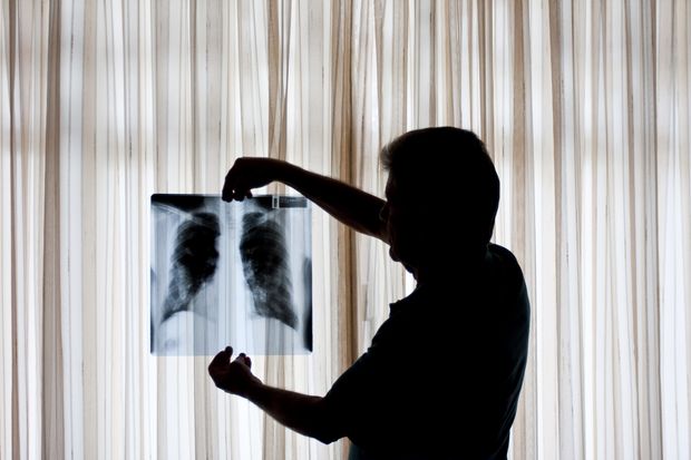 OSASCO, SP, BRASIL, 28-04-2010, 14h00: Ivo dos Santos trabalhou por 34 anos com exposicao direta ao amianto. Hoje ele tem asbestose, uma doenca que dificulta a respiracao e o impede de fazer exercicios. Na foto, ele segura o raio-x do seu pulmao. (Foto: Fred Chalub/Folha Imagem, SUPLEMENTOS/EMPREGOS) ***EXCLUSIVO FOLHA*** 3920