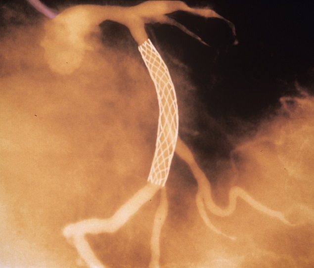 Exame de imagem mostra ao de stent, que desobstrui vasos sanguneos