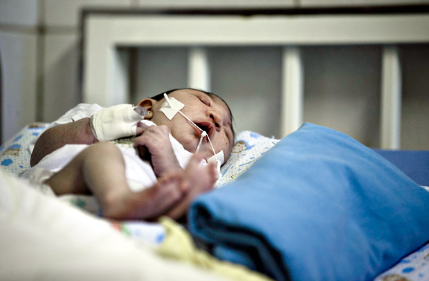 Bebê com microcefalia internada em hospital no Recife