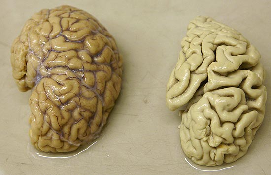 Imagem compara o hemisfério de um cérebro saudável (à esquerda) ao hemisfério do cérebro de uma pessoa que sofre de Alzheimer