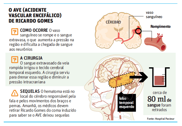 O Acidente Vascular Encefálico de Ricardo Gomes