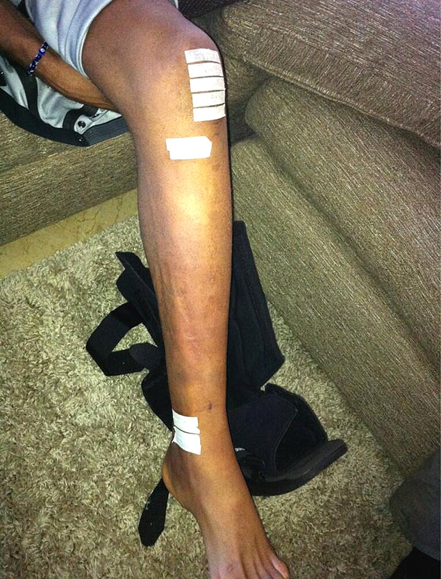 Anderson Silva mostra a perna, que foi operada