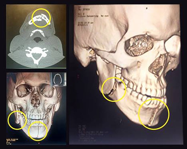 Exame de Bolaos mostra a mandbula dividida 