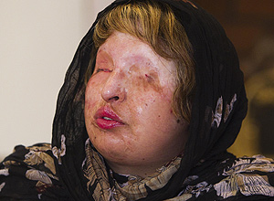 Ameneh Bahrami, que foi cegada com ácido por pretendente, perdoou agressor de ficar sem visão no último minuto
