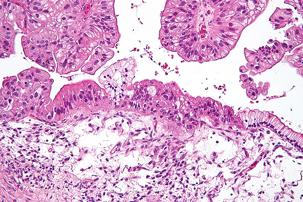 Clulas de cncer epitelial do ovrio