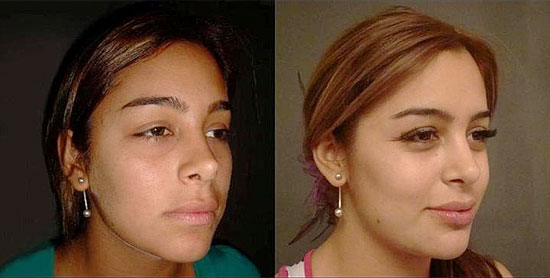 Larissa Riquelme antes (esq) e depois (dir) de fazer cirurgias plásticas no rosto
