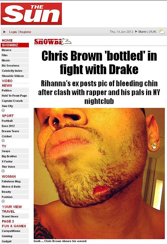 Jornal &quot;The Sun&quot; divulga foto do cantor Chris Brown machucado aps briga com Drake