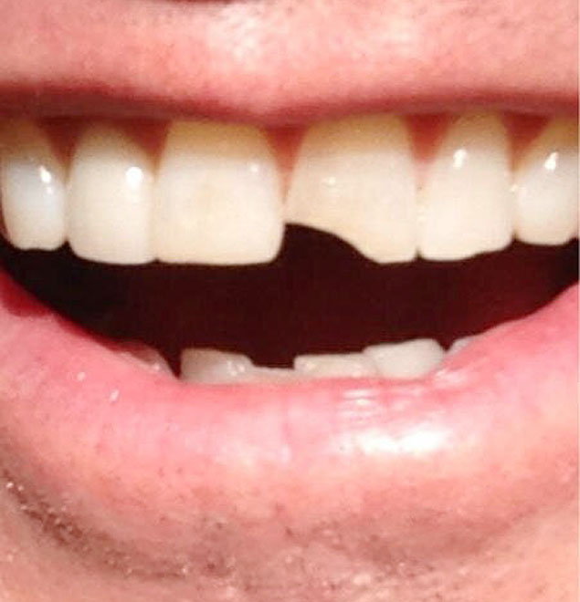 Jim Carrey posta foto de dente quebrado, marca de seu personagem em 'Debi e Lide'