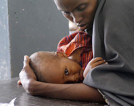 Mulher abraça filho subnutrido em hospital da Somália, onde a ONU deve declarar fome, dizem autoridades