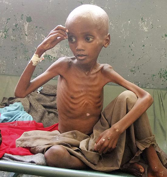 Algumas das crianas em pior estado de desnutrio so tratadas no hospital de Banadir, na capital da Somlia