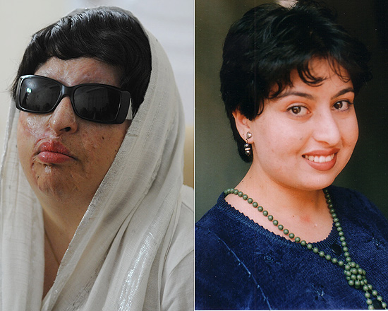 Imagens mostram Ameneh Bahrami antes do ataque, em 2004, (acima) e agora, em visita a Teerã, depois do tratamento (à esq.) ao qual foi submetida em Barcelona, na Espanha, com a ajuda financeira do governo iraniano