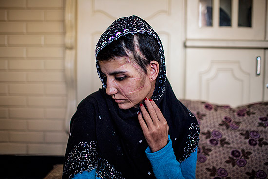 Gul Meena mostra as cicatrizes que se formaram em seu rosto aps seu irmo atac-la com um machado