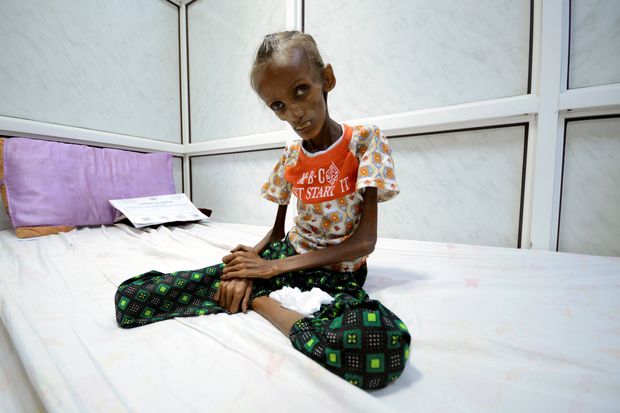 Saida Ahmad Baghili, 18, que sofre de desnutrição severa, em hospital do Yêmen