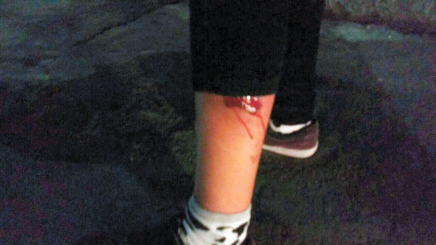 A perna da estudante L.L, que foi atingida por estilhaços de bomba na Rua da Consolação