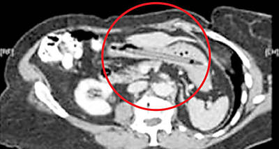 Raio-x abdominal mostra objeto que foi engolido acidentalmente por uma mulher inglesa
