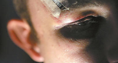 Marcas da agressão sofrida por, P.R.; ele teve um osso da face fraturado no último domingo