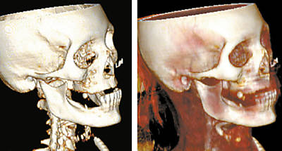 Imagens de tomografia do primeiro corpo submetido a autpsia virtual