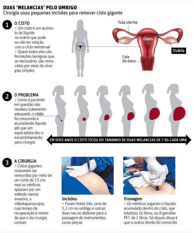 Bem Estar - HC retira cisto gigante de ovário por cirurgia minimamente  invasiva