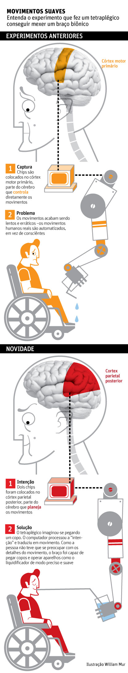 Chip no cérebro permite a tetraplégico voltar a mover a mão