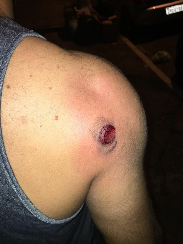 O analista administrativo João Marcelo Zalkauskas, 31, foi atingido por uma bala de borracha nas costas no bloco MinhoQueens