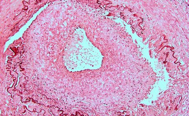 Imagem de uma artéria temporal danificada por arterite de células gigantes (GCA, sigla em inglês)