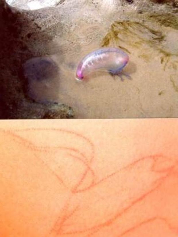 Caravelas deixam linhas avermelhadas na pele, por causa de seus tentáculos