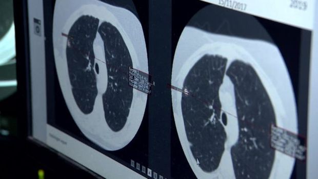 O câncer de pulmão costuma dar sinais muito precoces de existência