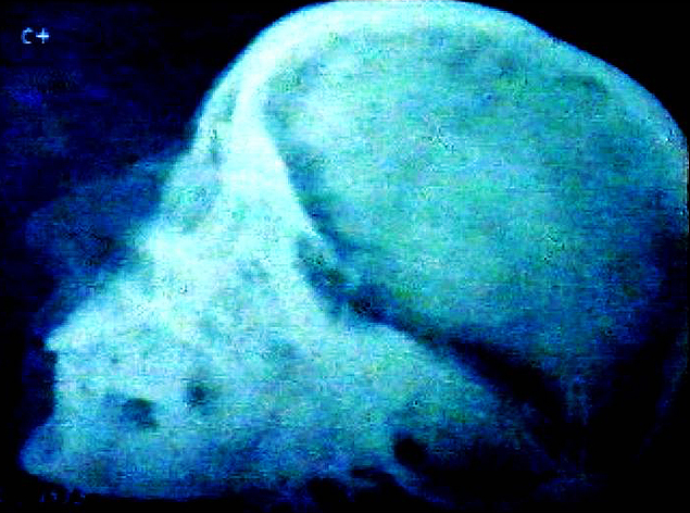 Imagens do raio-x do crnio de Eva Pern feitas pelos militares em seu cadver, em 1955