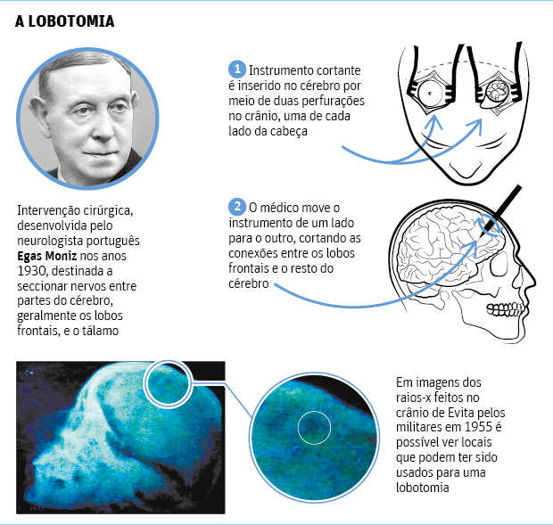 Lobotomia