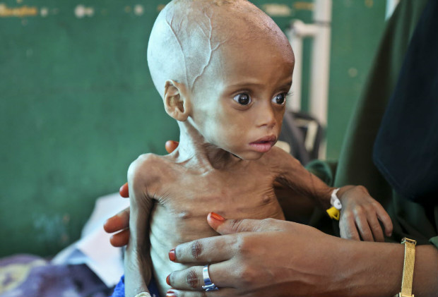 Desnutrido, bebê de nove meses recebe tratamento em hospital de Mogadício, capital da Somália