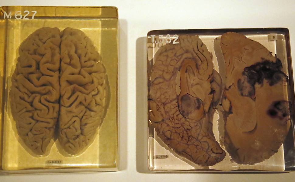 Cérebros de pessoas doentes também fazem parte da mostra