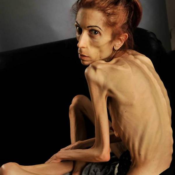 Americana mostra recuperação pós-anorexia