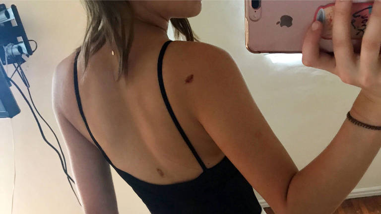 Elsie Hewitt tirou foto mostrando os hematomas causados pelo ex-namorado Ryan Phillippe
