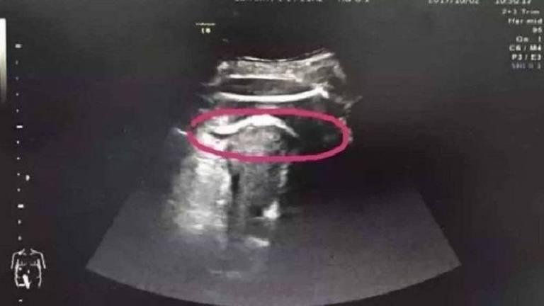 Ultrassom mostra perna do feto para fora das paredes uterinas
