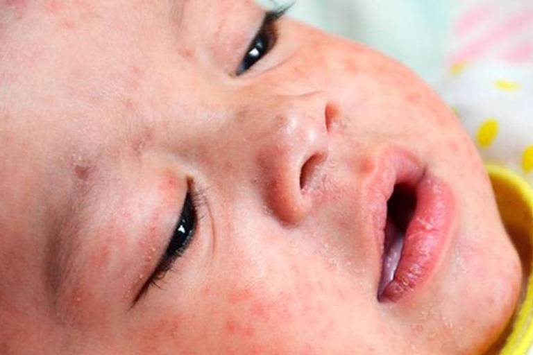 Bebê com marcas avermelhadas de sarampo no rosto