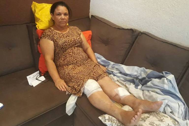 Foto mostra uma das vítimas do atropelamento em ponto de ônibus em Guarulhos, Silvaneide Maria da Silva, sentada em um sofá com várias feridas nas duas pernas