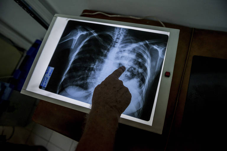médico examina raio-x de paciente com tuberculosi