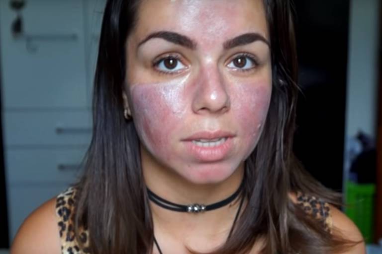 A youtuber Lorena Rodrigues, 25, que mostrou como procedimento caseiro deu errado