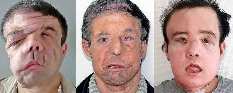 Da esquerda para a direita: Jérôme  Hamon, que tem neurofibromatose, antes de seus transplantes; após a primeira cirurgia, em 2010; e depois do segundo, este ano