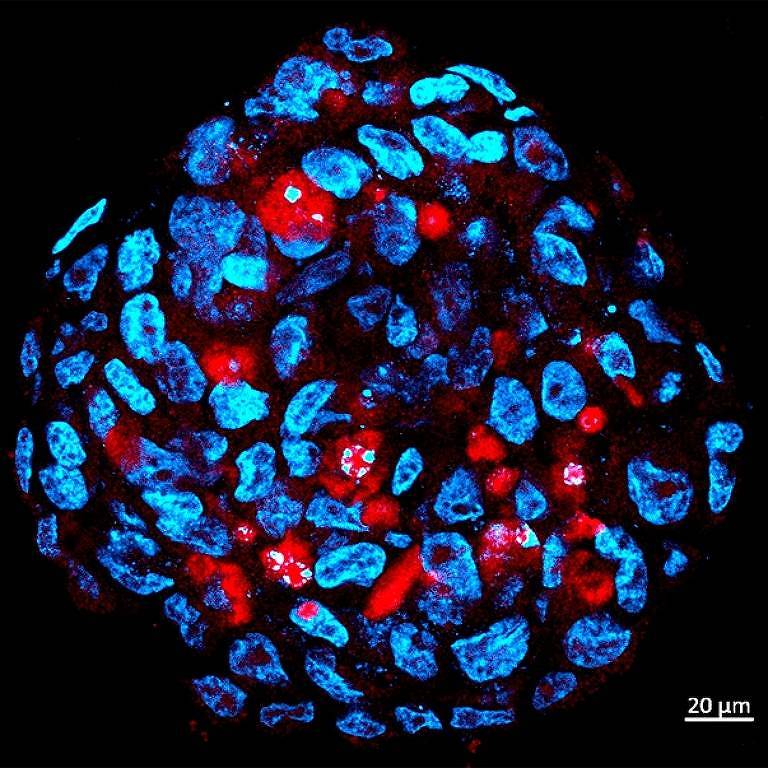 Esfera tumoral composta por cÃ©lulas-tronco de meduloblastoma humano, infectadas por ZIKA (vermelho)